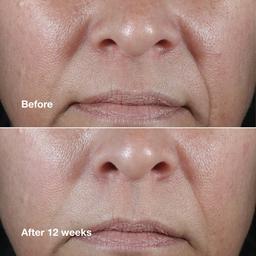 Clinique Smart Clinical Repair™ Wrinkle Correcting Rich Cream