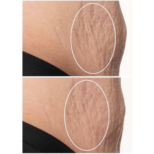 StriVectin&#174; SD Advanced&#8482; PLUS Intensive Moisturizing Concentrate