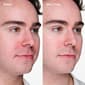 Clinique Acne Solutions Clinical Advanced Clearing Gel - image 4
