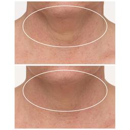 StriVectin®-TL™ Advanced Tightening Neck Cream w/ Alpha 3 Peptide