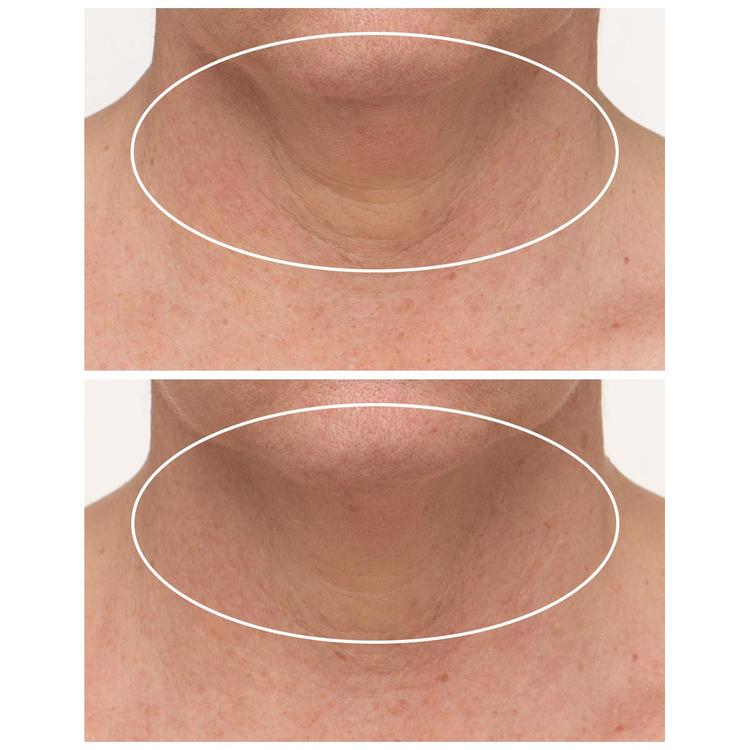 StriVectin®-TL™ Advanced Tightening Neck Cream w/ Alpha 3 Peptide