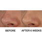 Clinique Blackhead Solutions Self-Heating Blackhead Extractor - image 6