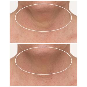 StriVectin(R)-TL(tm) Advanced Tightening Neck Cream w/ Alpha 3 Peptide alternate view